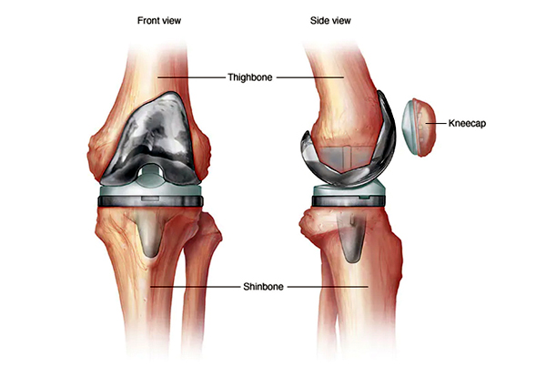 Knee Replacement Surgery