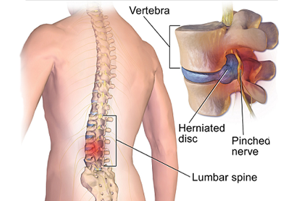 Spine Surgery