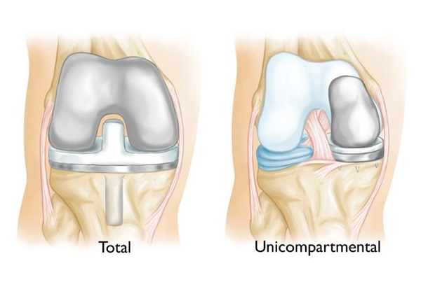 Partial Knee Replacement