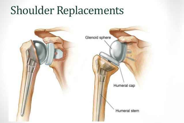 Shoulder Replacement Surgery