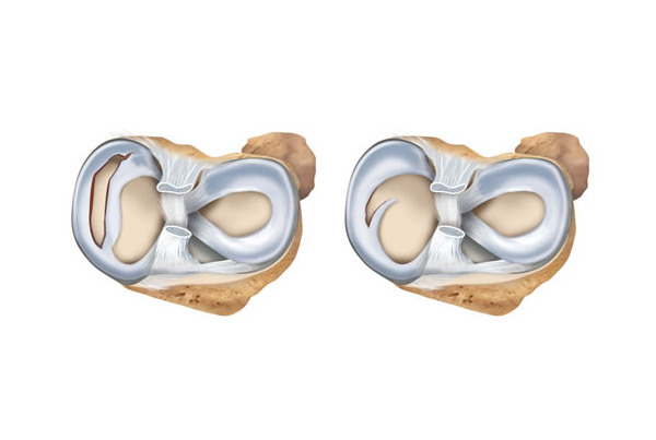 Meniscus Tear